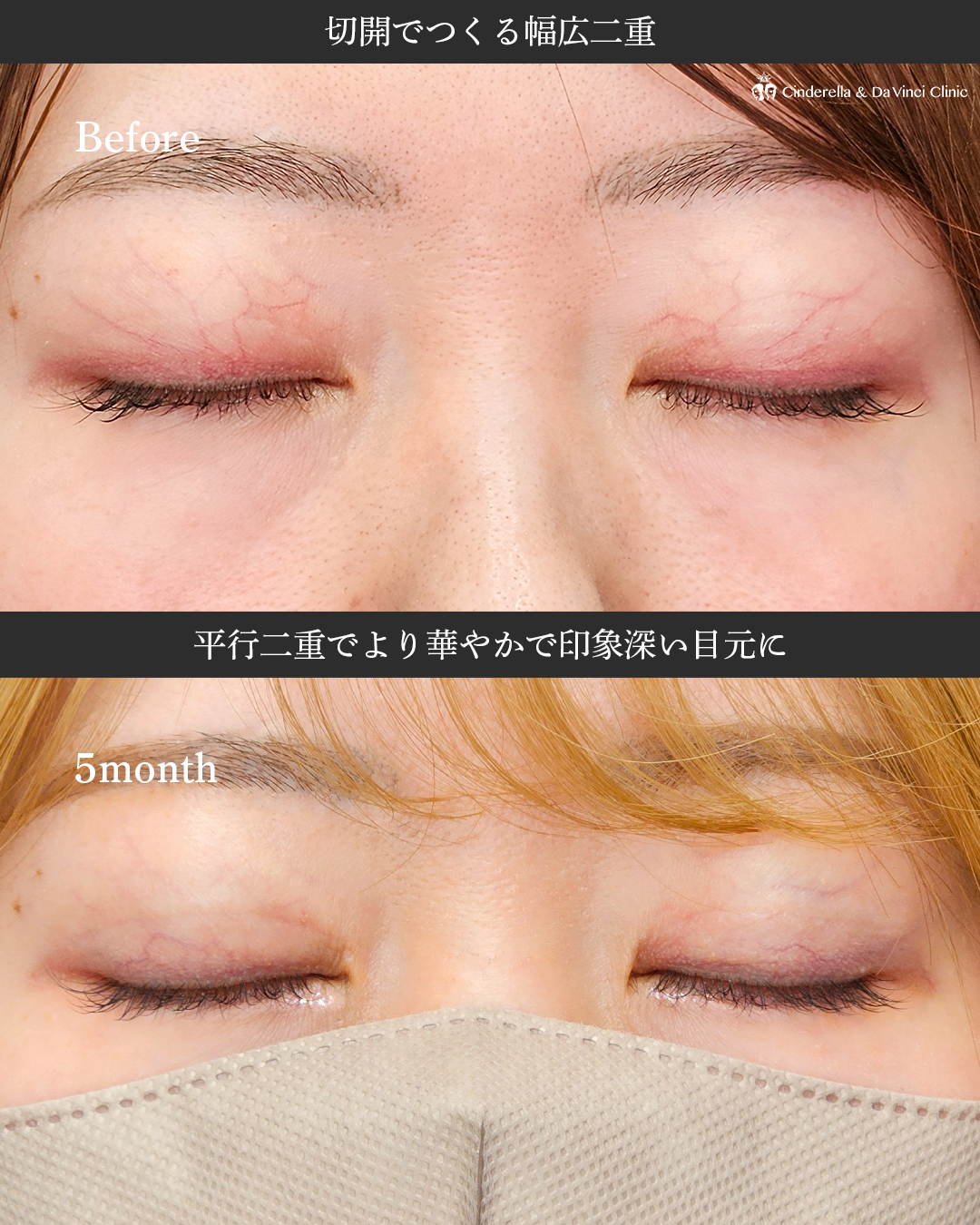 全切開で平行二重をつくるの画像