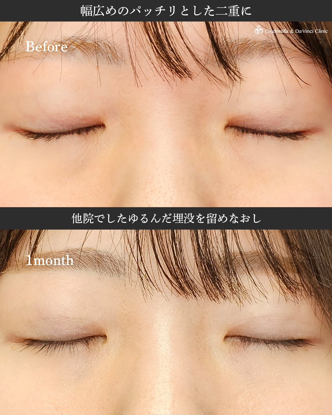 ゆるんだ埋没をパッチリ二重にの画像