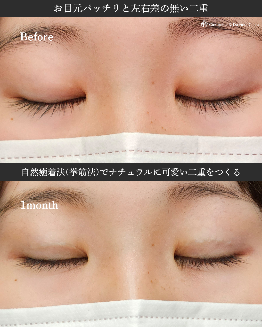 ナチュラルな二重の画像