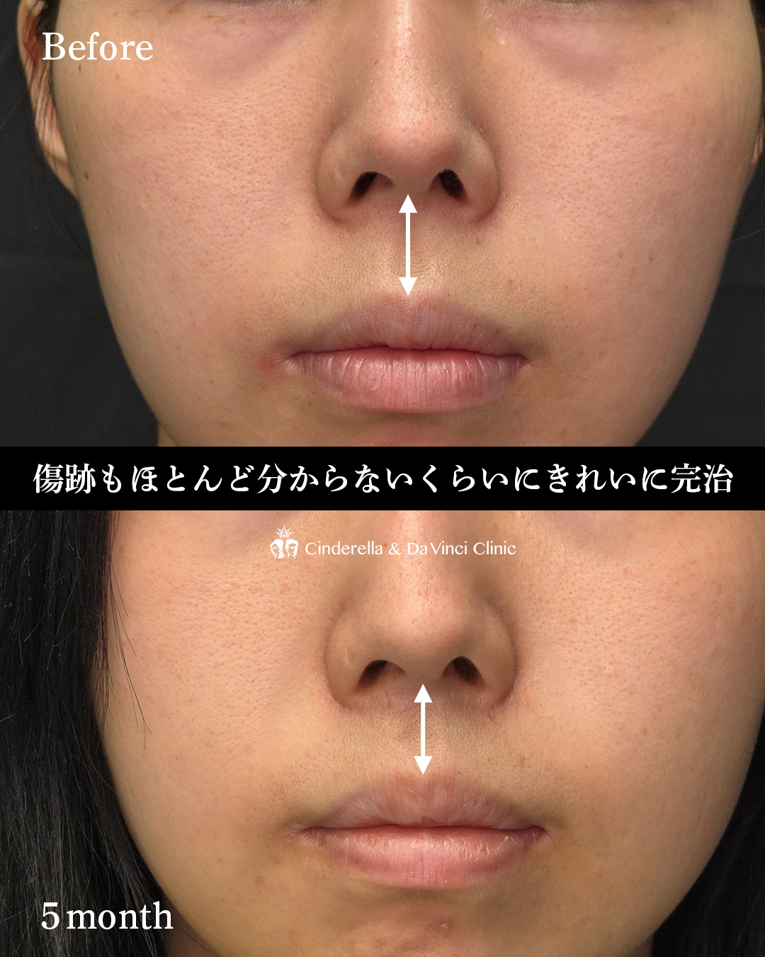 人中短縮で中顔面短縮の画像