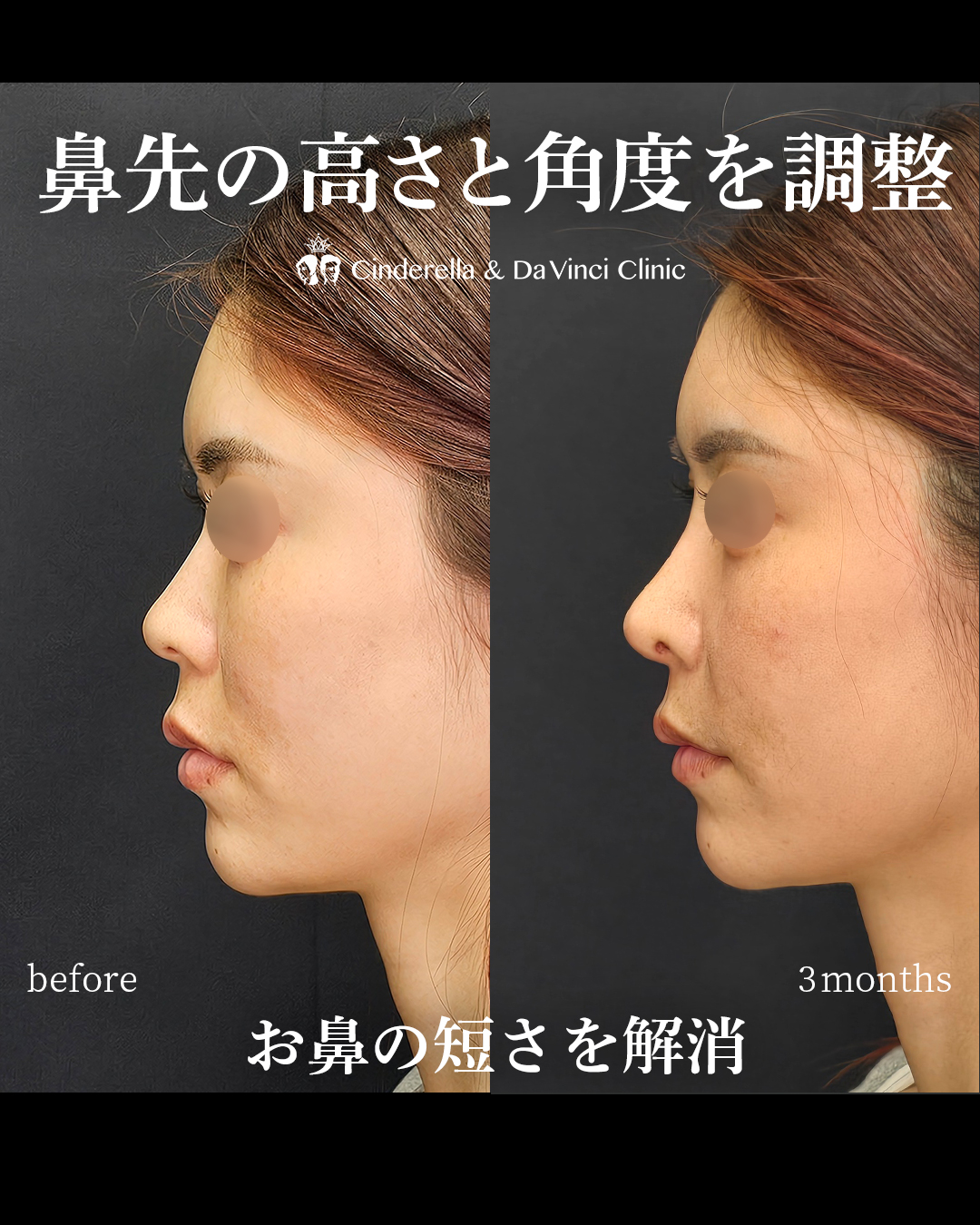 短い鼻を改善する鼻整形の画像