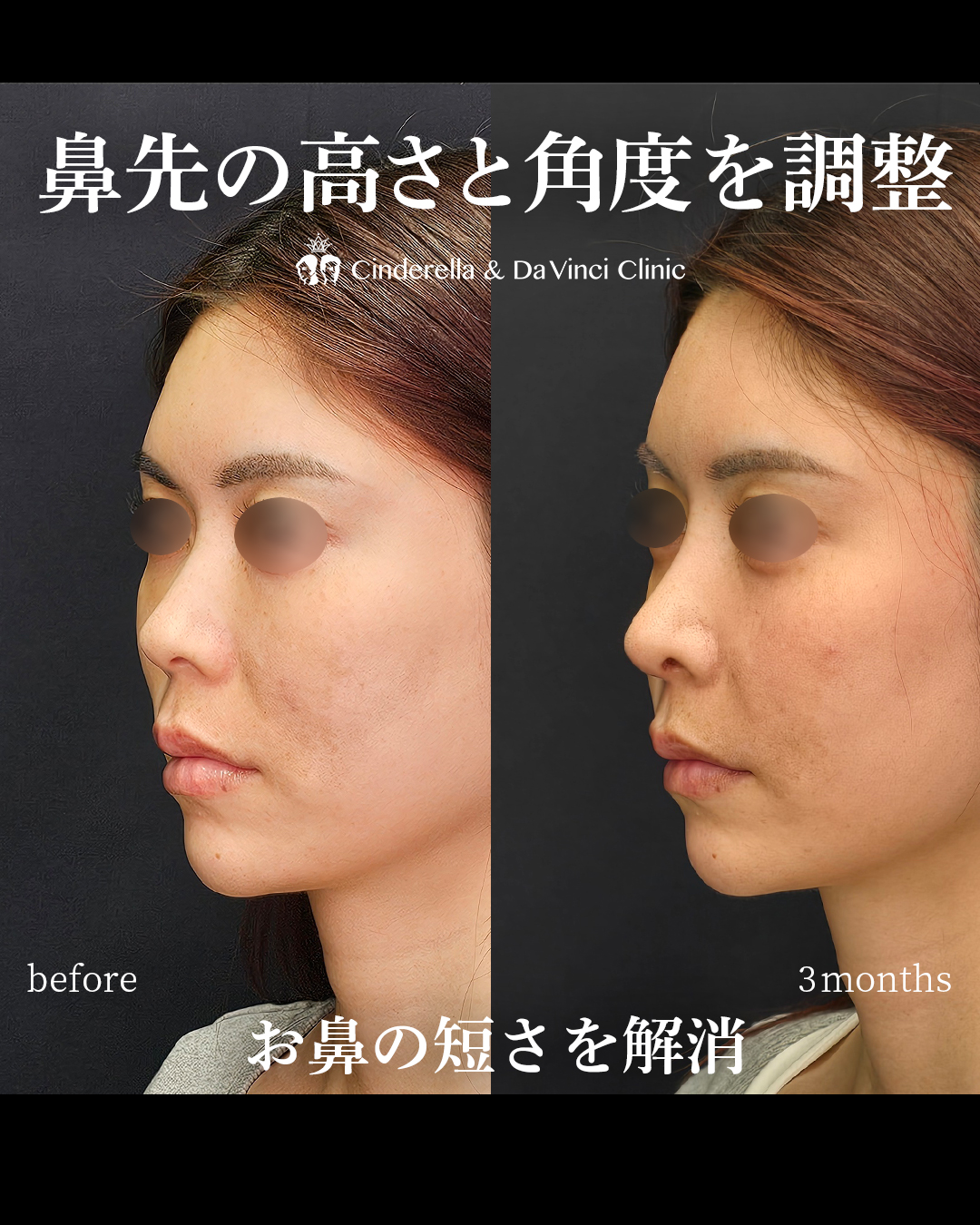短い鼻を改善する鼻整形の画像