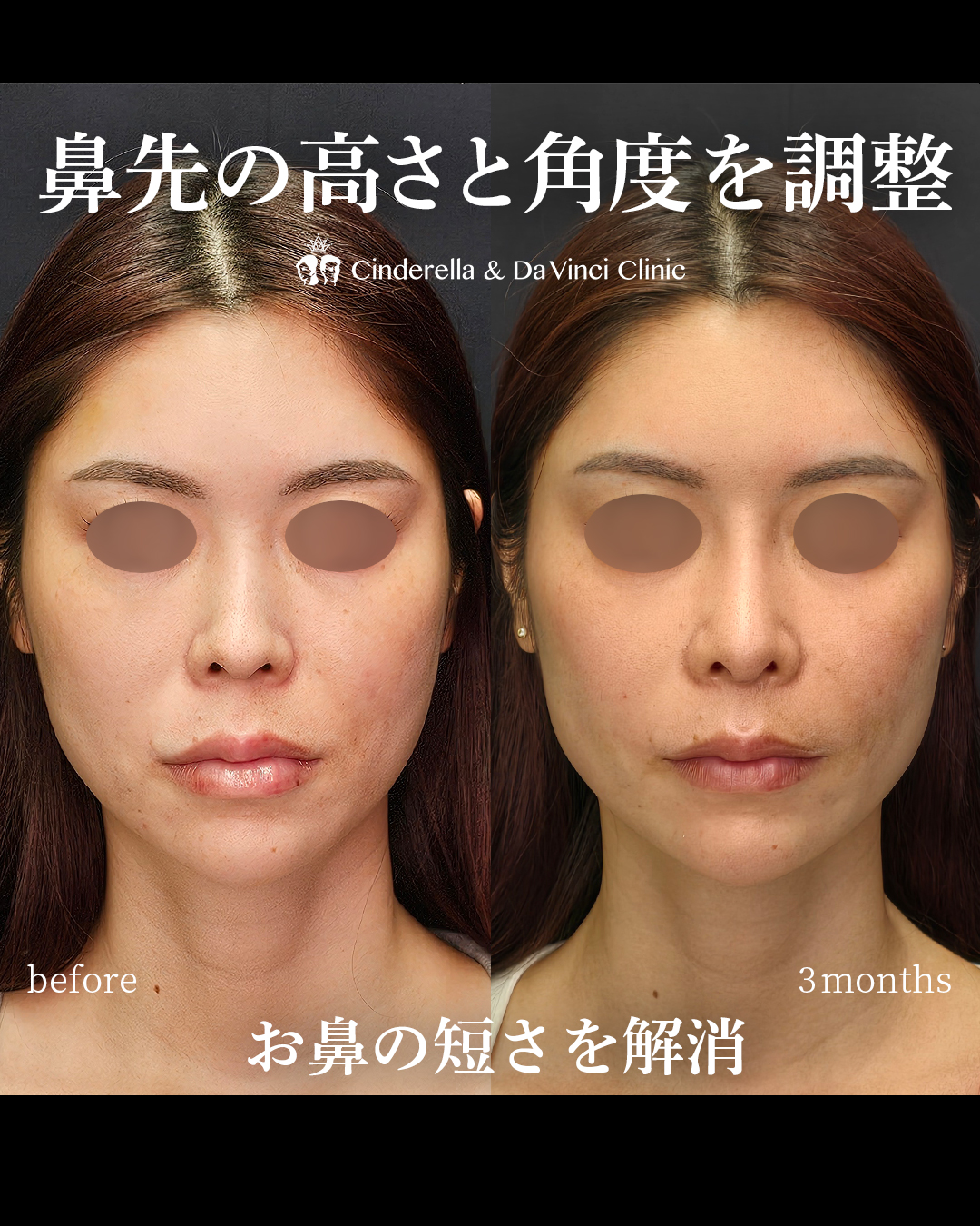 短い鼻を改善する鼻整形の画像