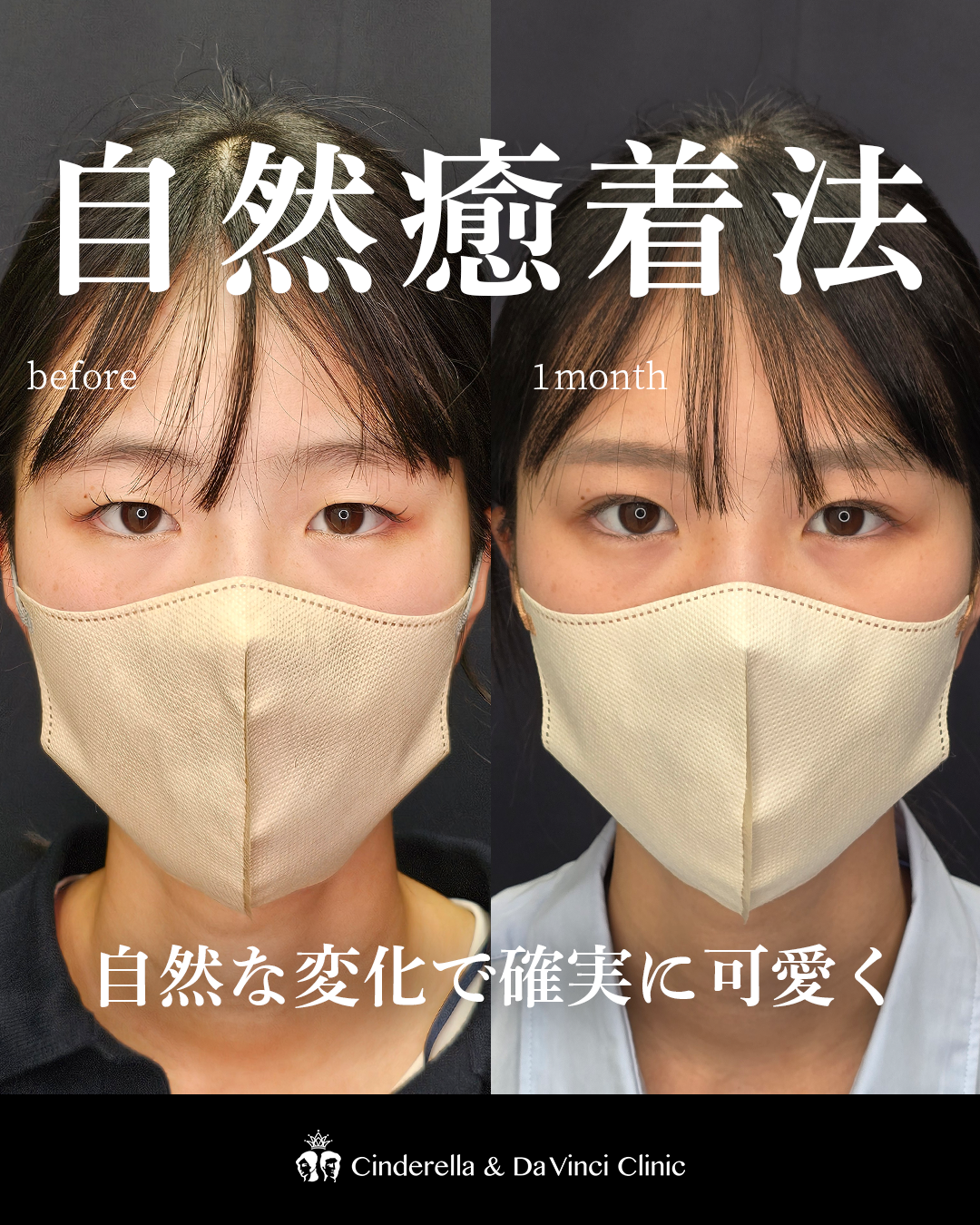 末広二重で自然な変化を出すの画像
