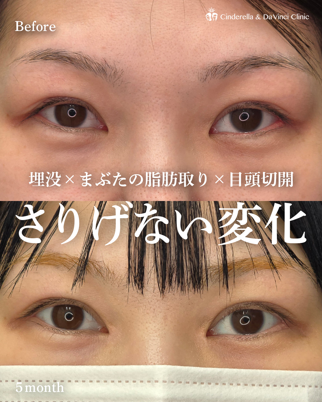埋没とまぶたの脂肪取りと目頭切開の画像