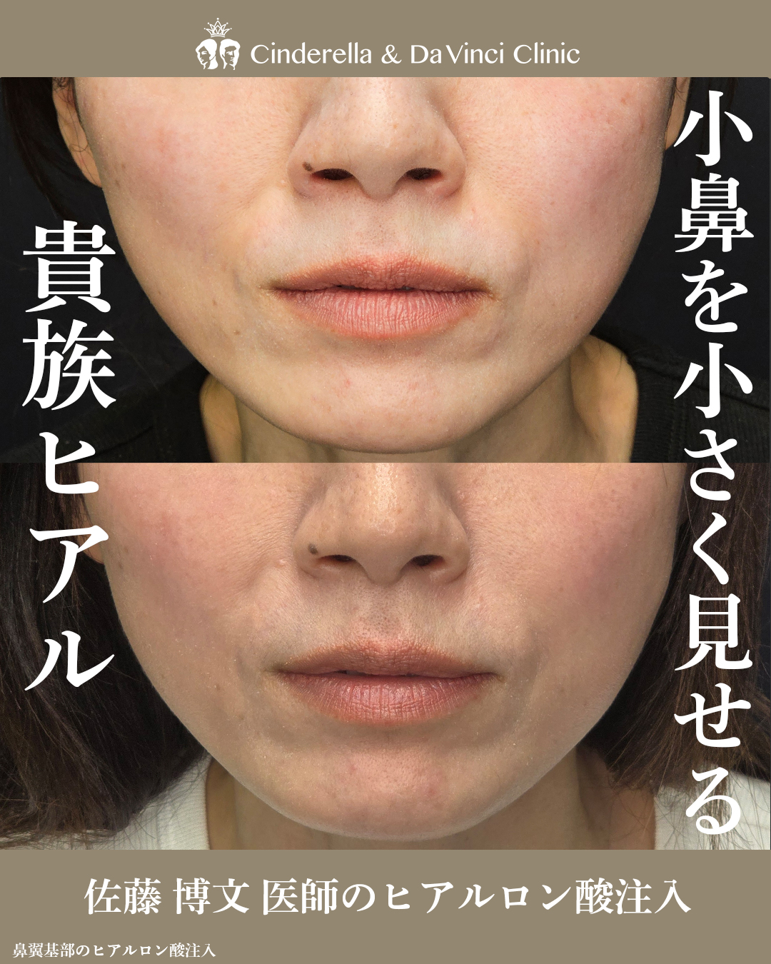 小鼻を小さく見せる貴族ヒアルの画像