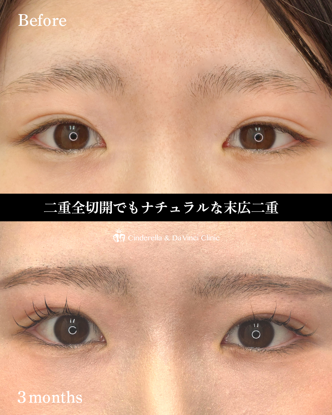 全切開でつくる末広二重の画像