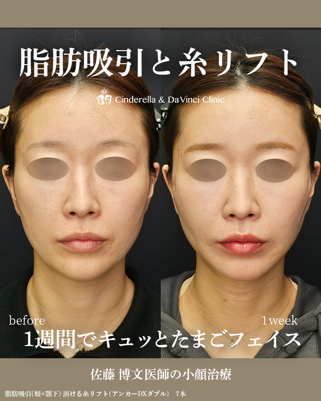 顔の脂肪吸引1週間のダウンタイムの画像