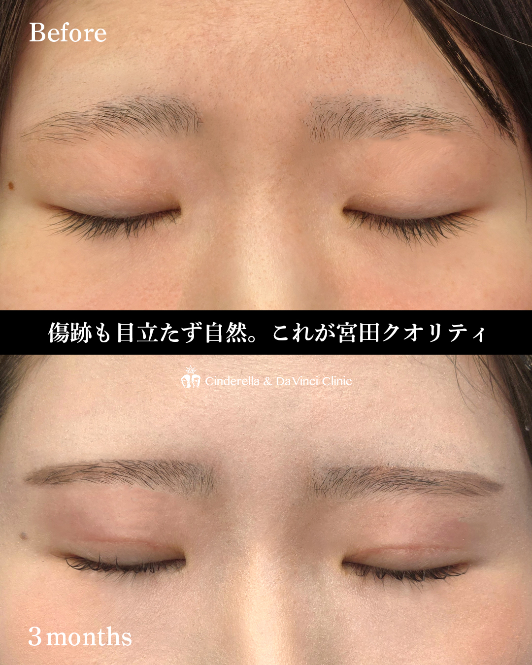 全切開でつくる末広二重の画像