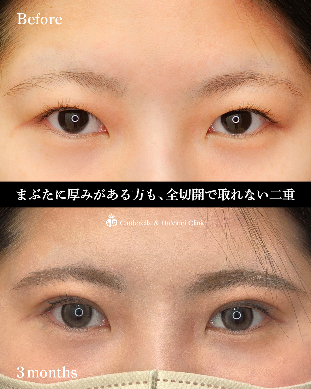 まぶたが厚い人は二重全切開の画像