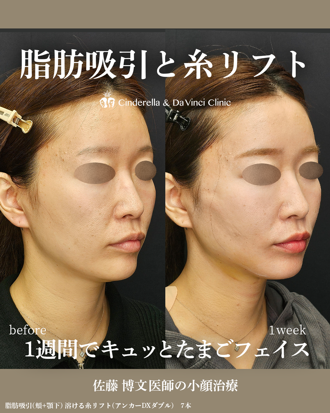 顔の脂肪吸引1週間のダウンタイムの画像