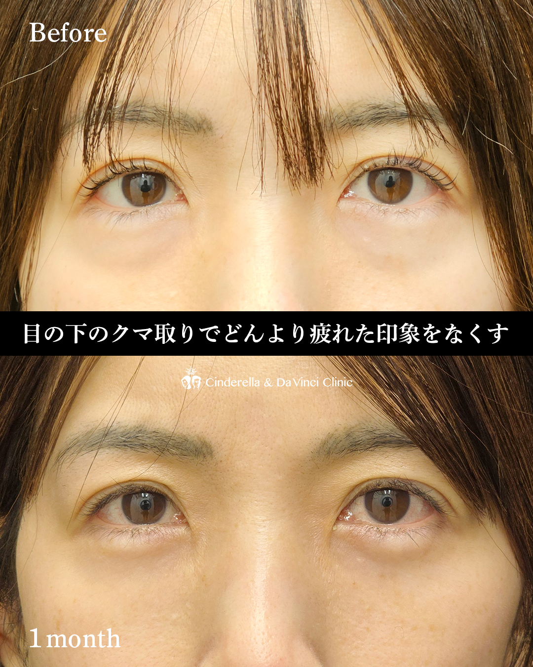 皮膚に傷がつかないクマ取りの画像