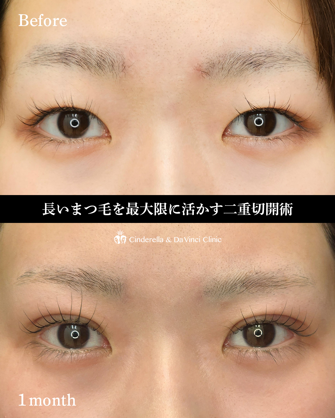 ダウンタイム中もきれいな二重切開の画像