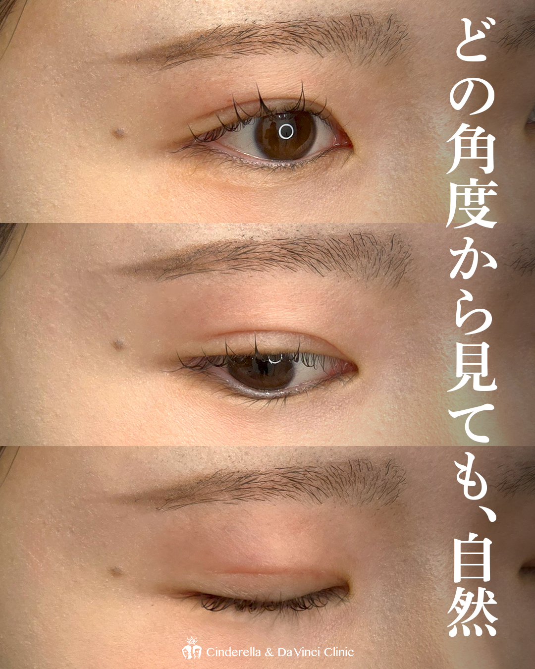 全切開でつくる末広二重の画像