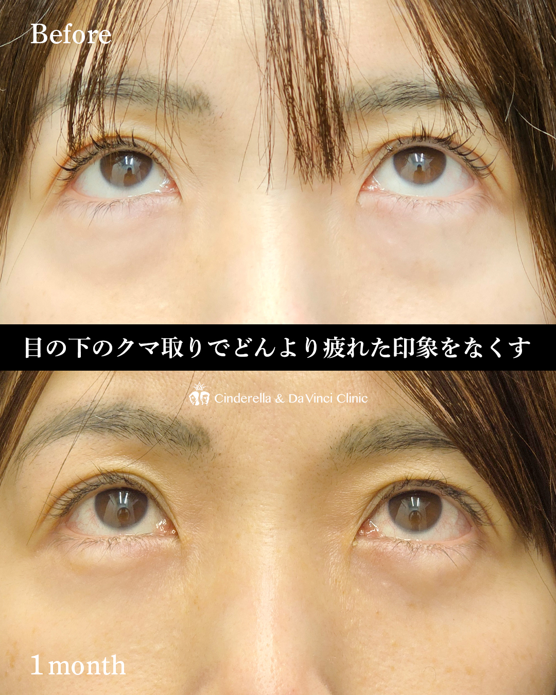 皮膚に傷がつかないクマ取りの画像