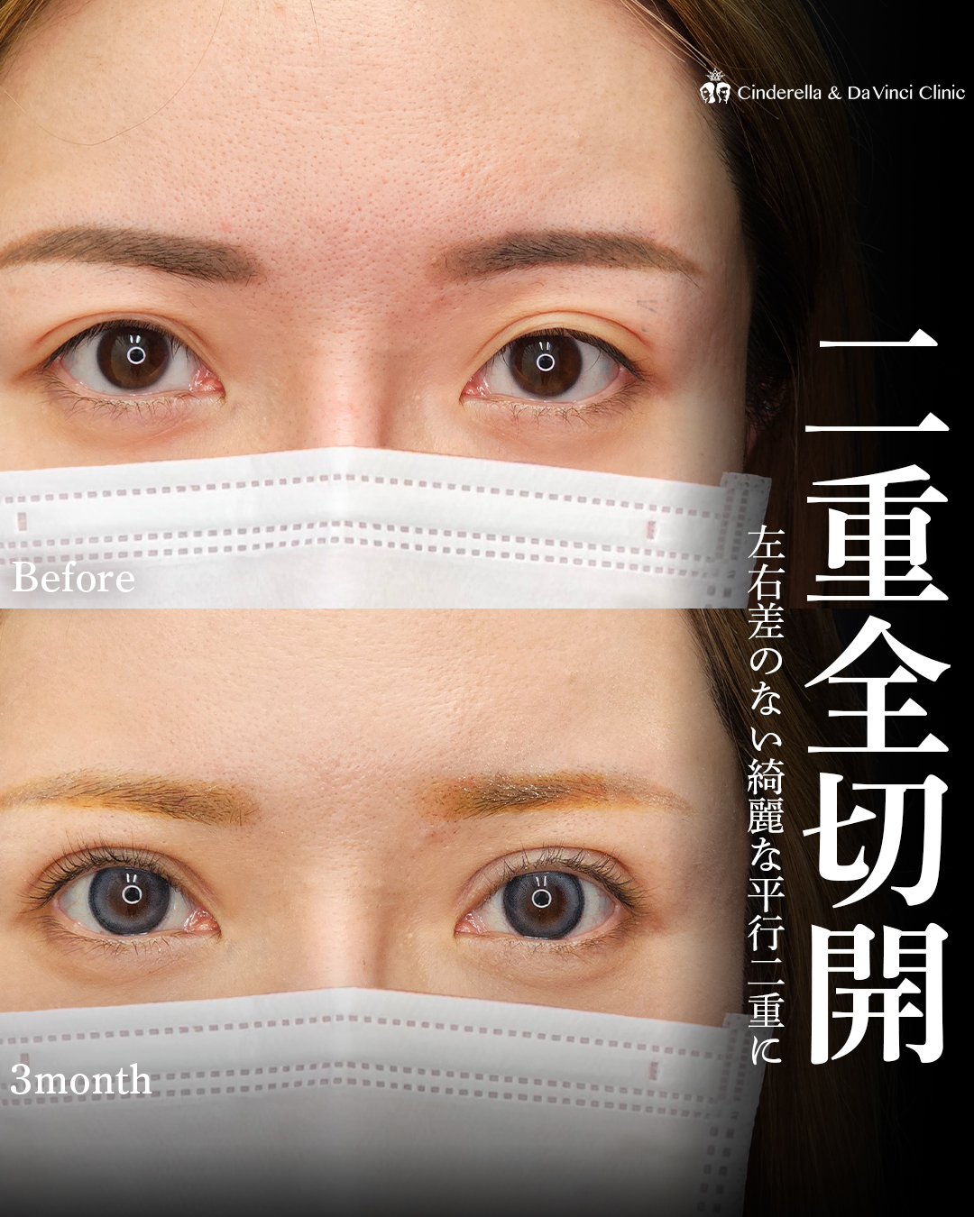 全切開で左右対称の平行二重の画像