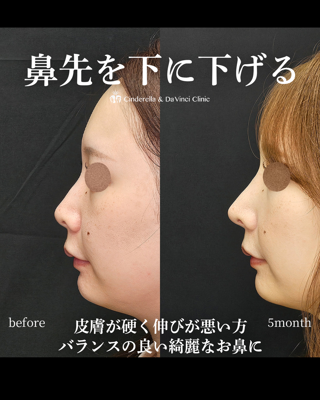 鼻先を下げる鼻整形の画像