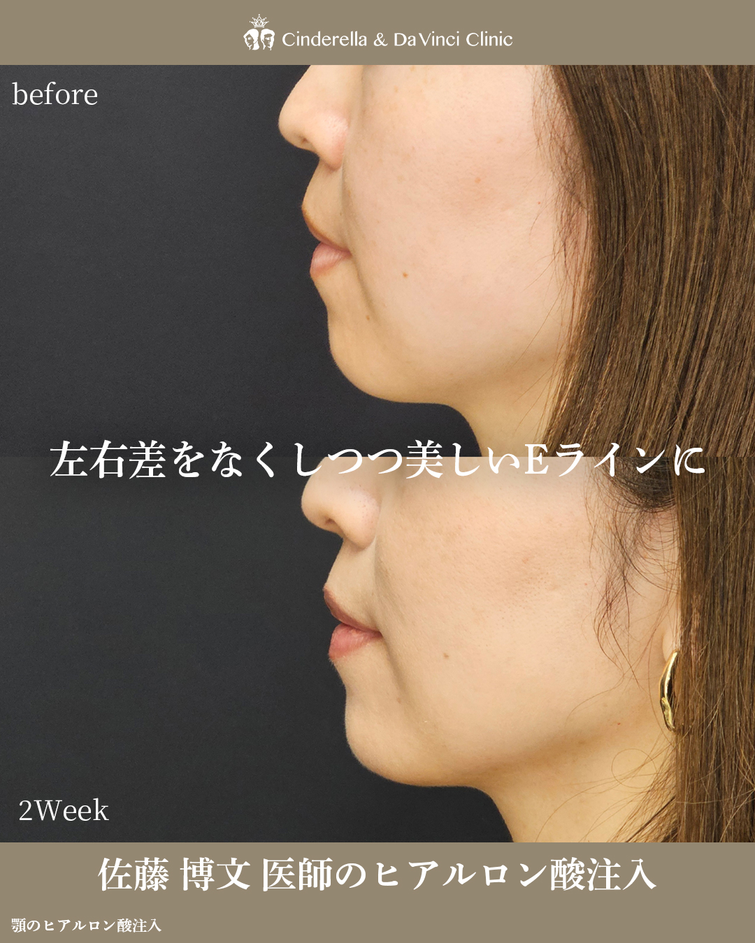 左右差を整えて美しいEラインにの画像