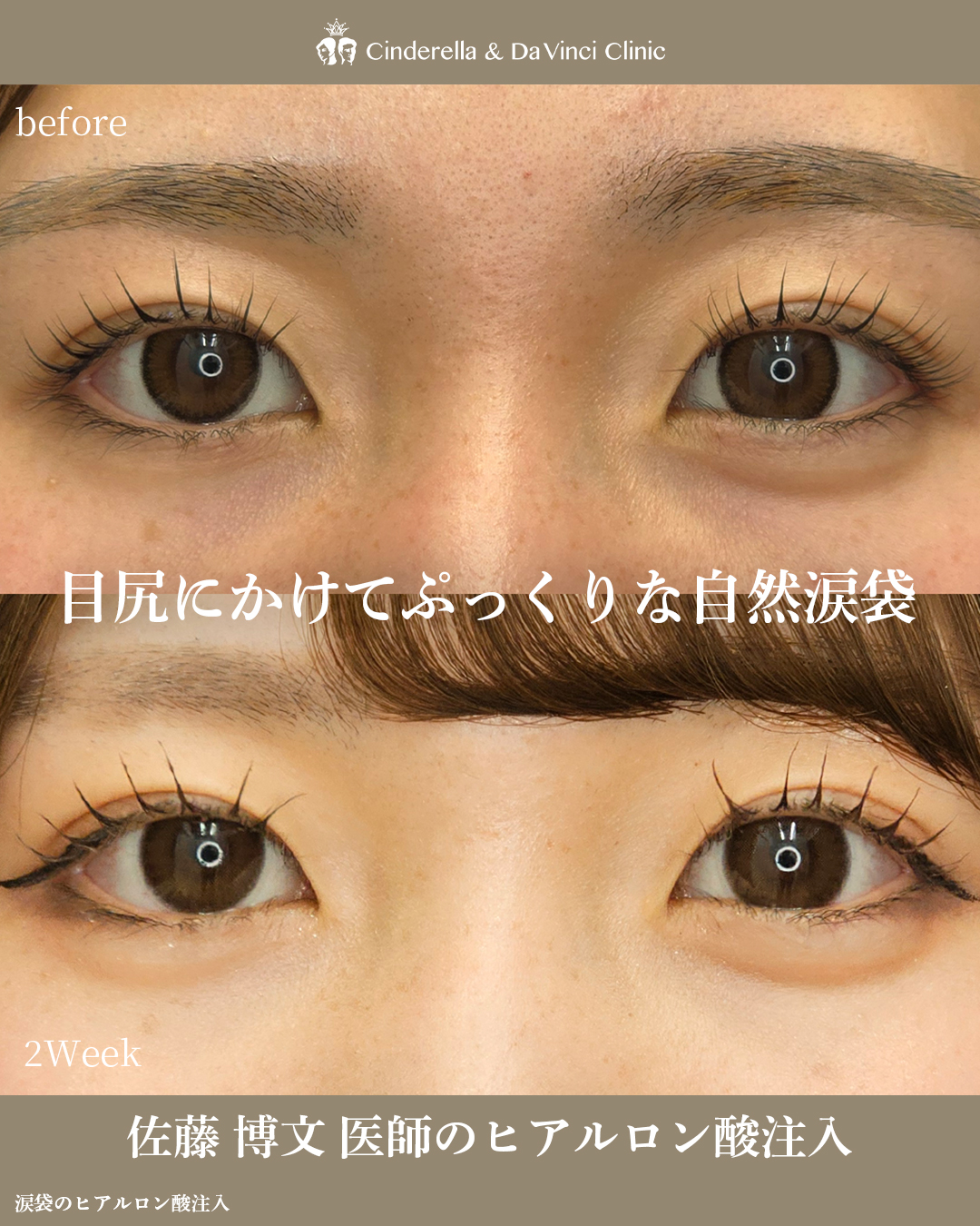 自然なぷっくり涙袋の画像