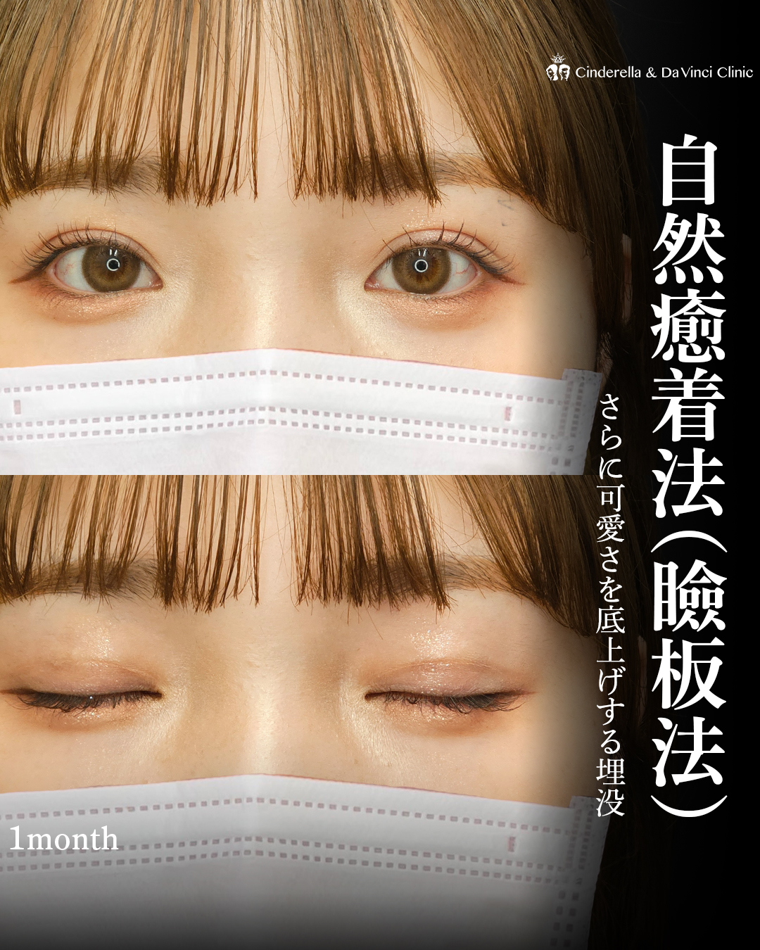可愛さを底上げする二重埋没の画像