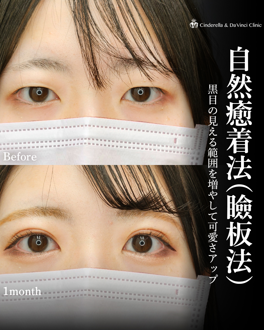 二重埋没で印象変化!可愛さUPの画像