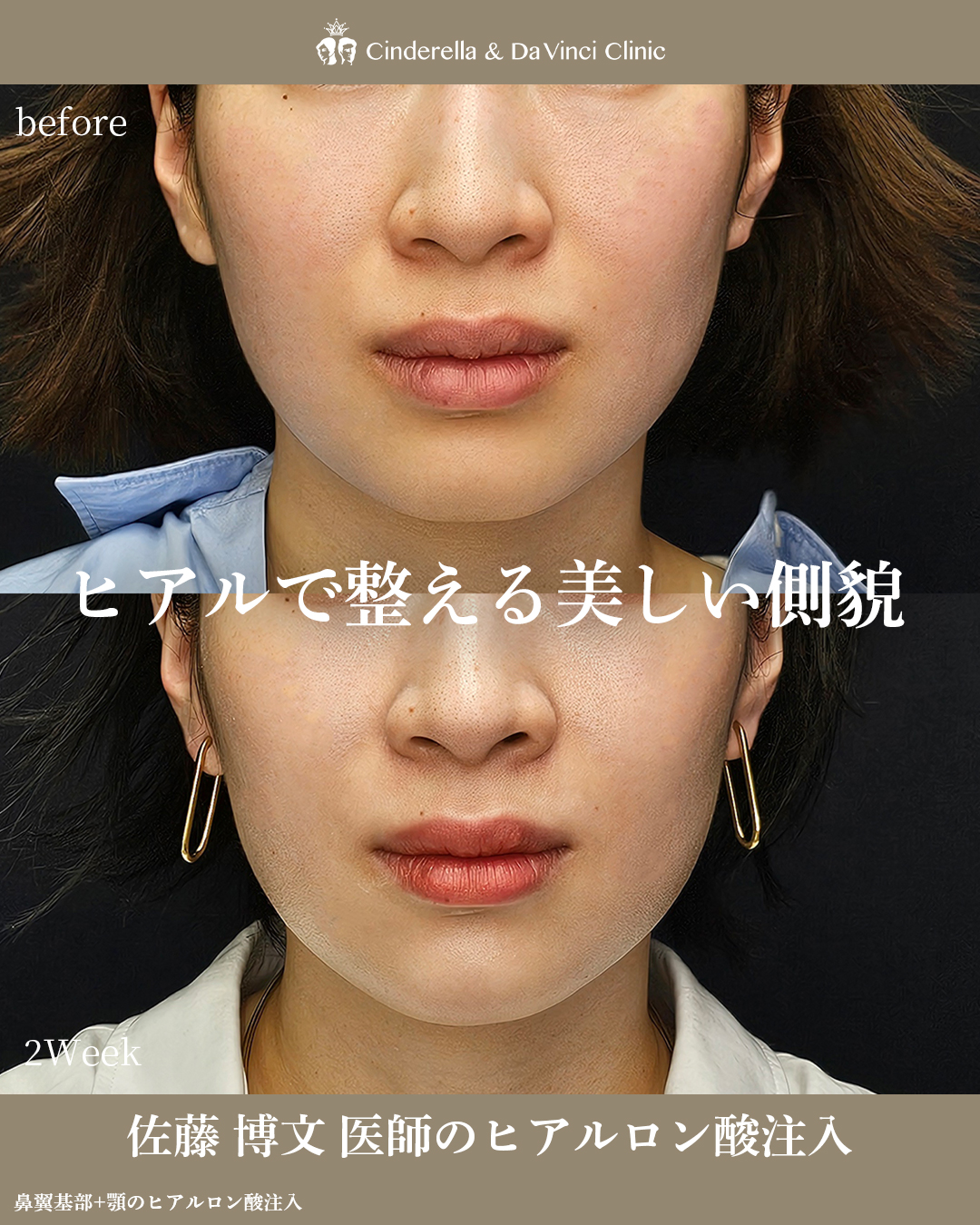 ヒアルで整える美しい側貌の画像