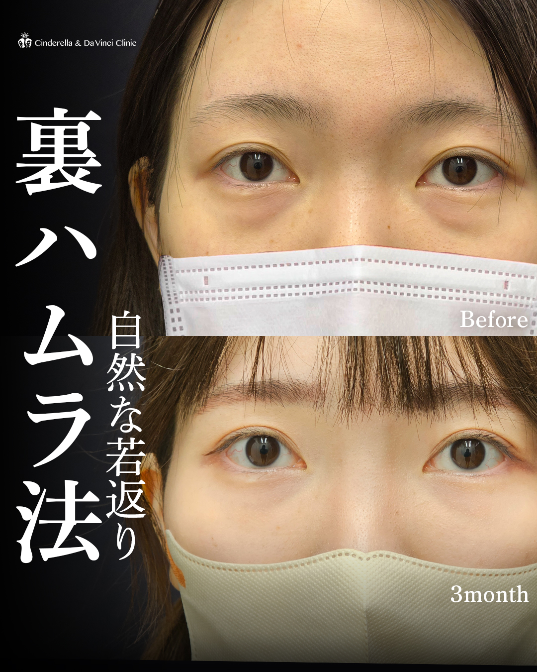 目の下のたるみを根本改善の画像