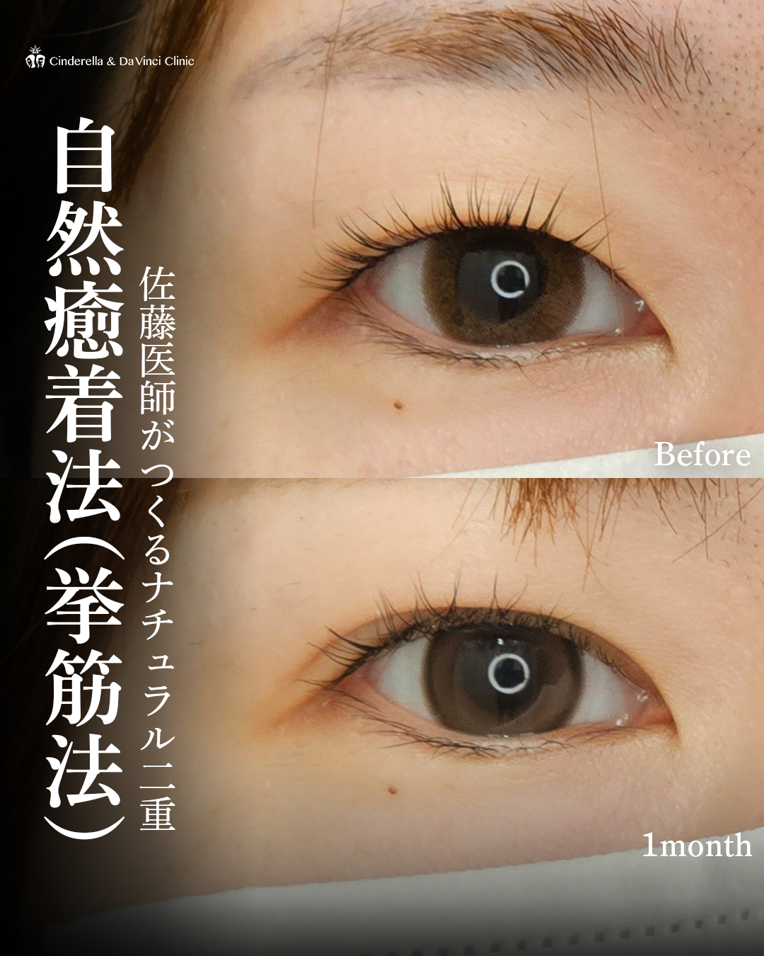 佐藤医師が作る自然な二重の画像