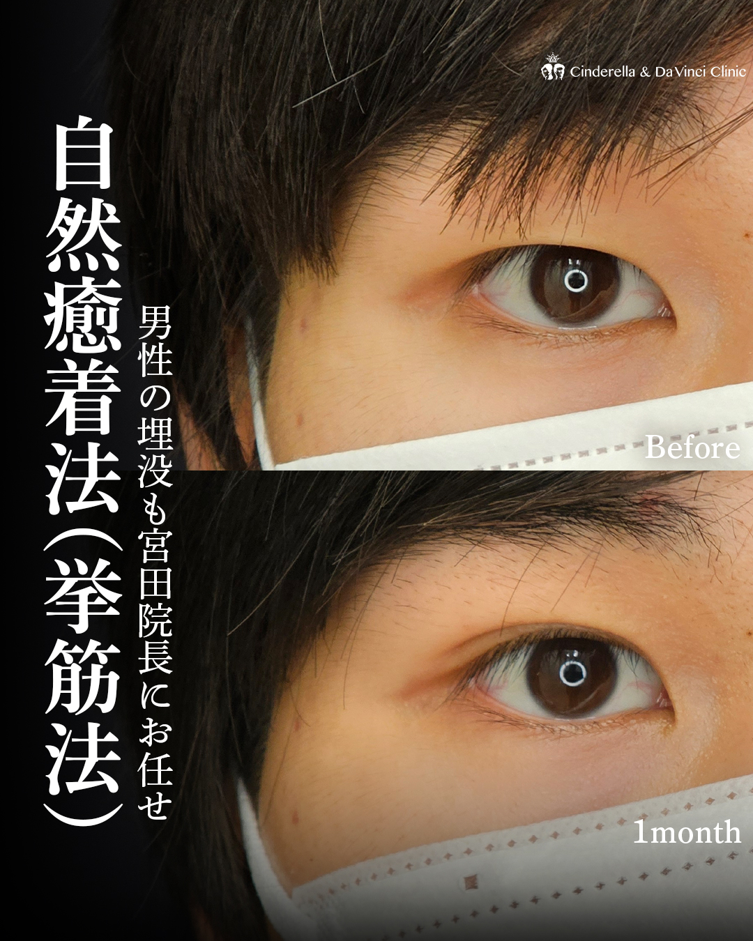 一重から自然な二重にの画像
