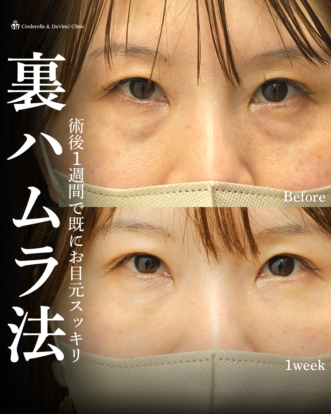 裏ハムラ法1週間で既にスッキリの画像