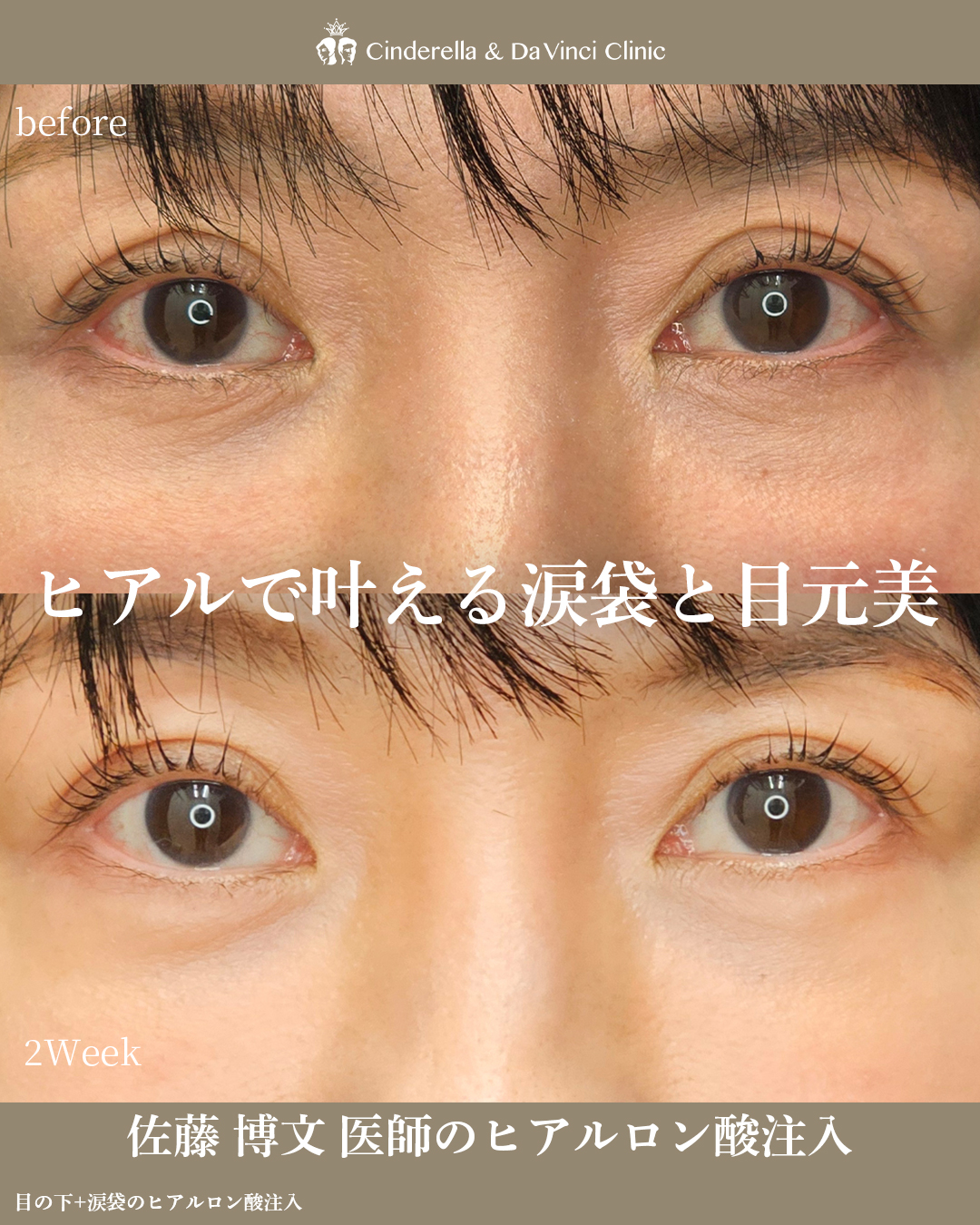 ヒアルで叶える目元美の画像