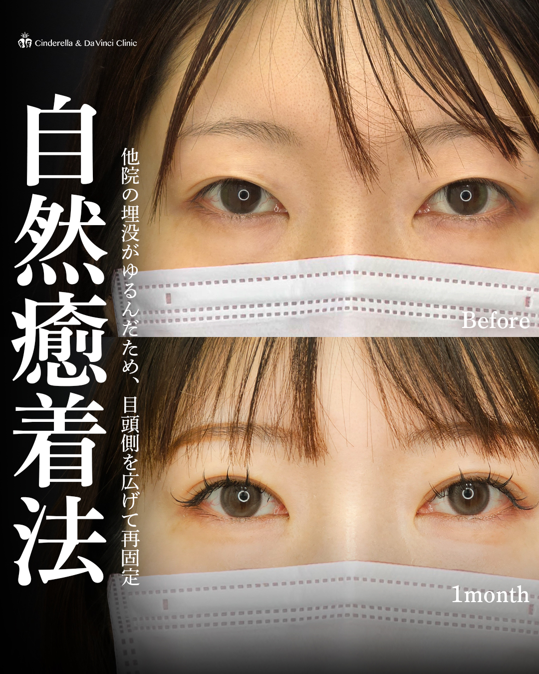 お顔に似合う魅力的な二重にの画像