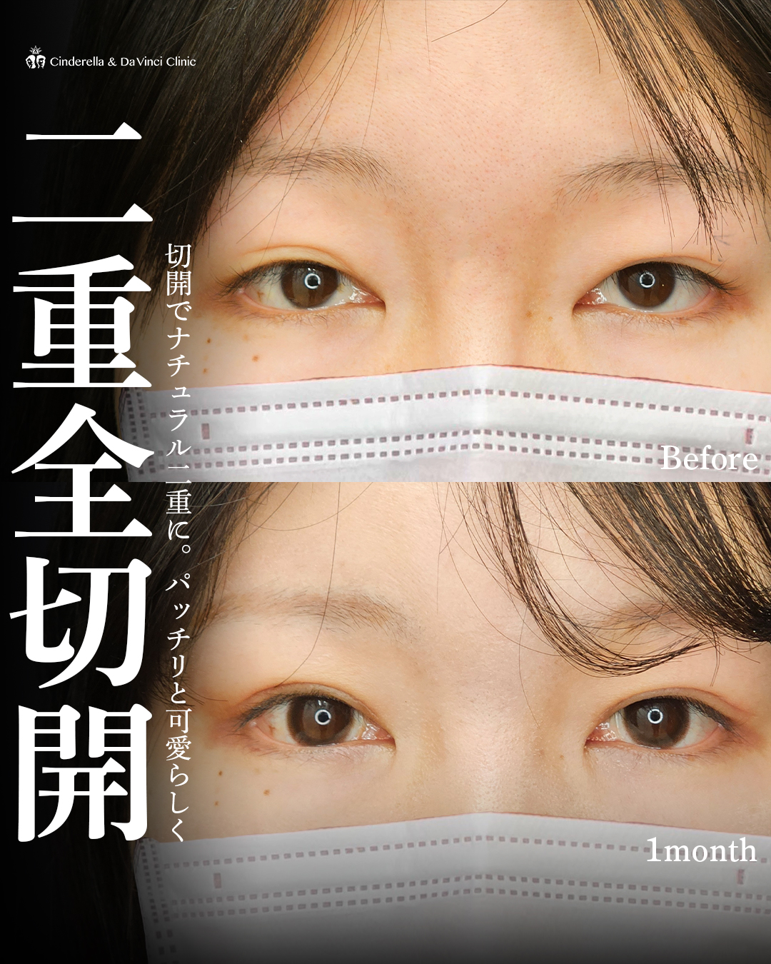 二重全切開で綺麗な二重にの画像