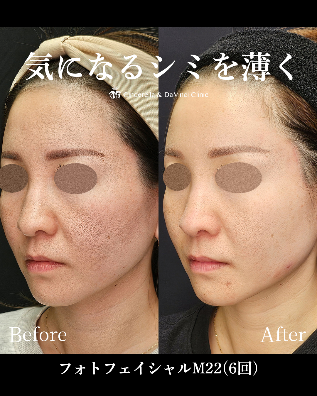 シミ悩みを解消する美肌施術の画像