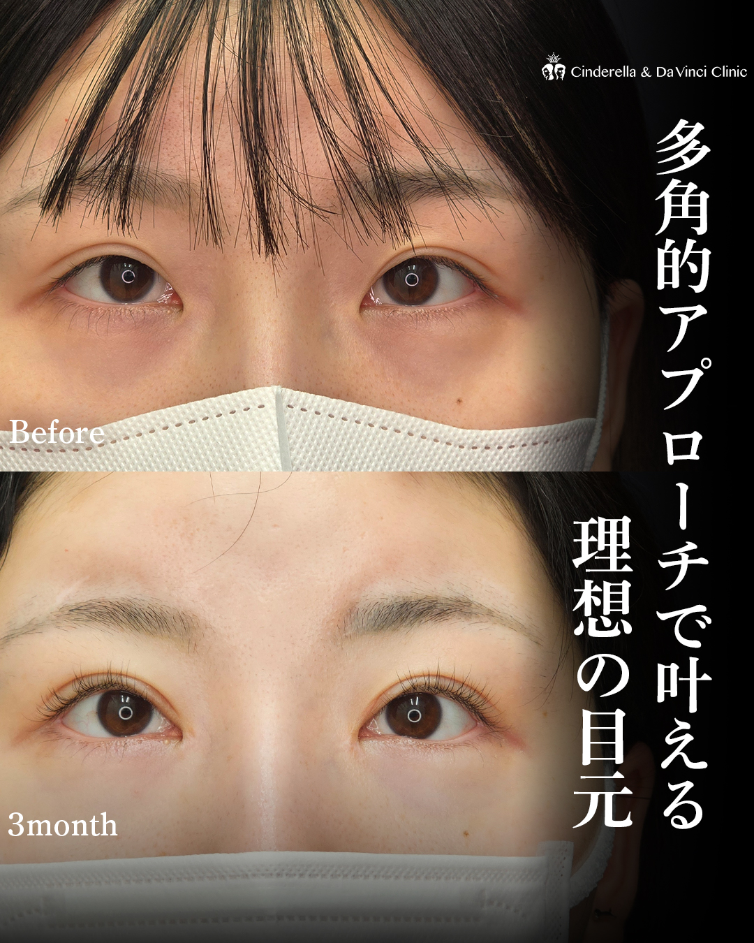 3術式で叶える理想の大きな目の画像
