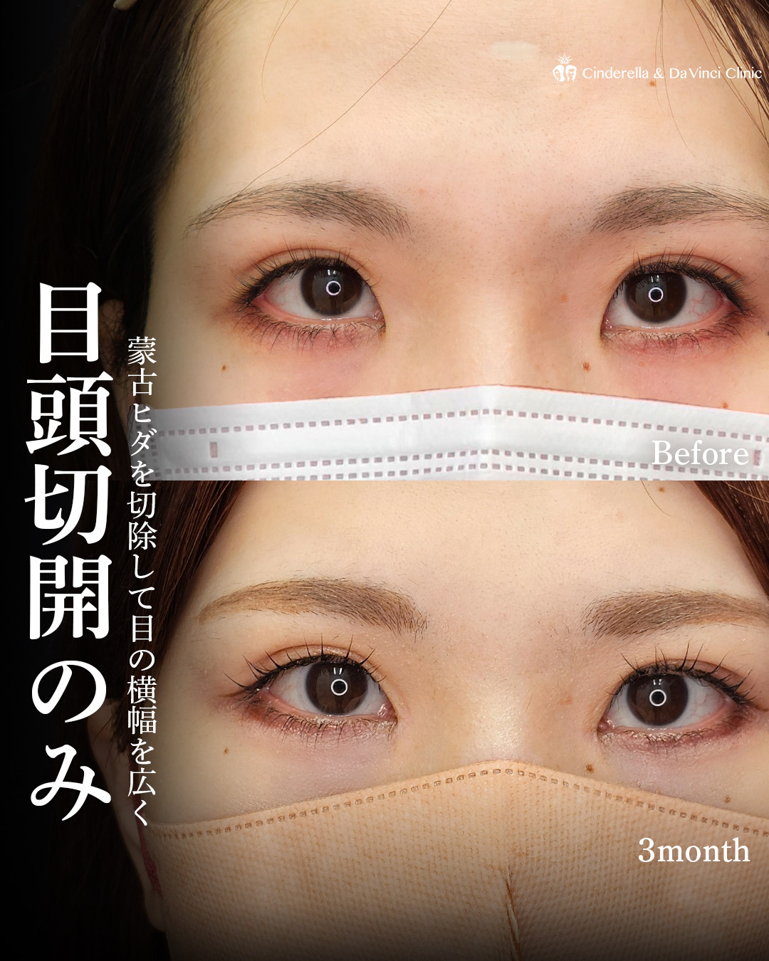 目頭切開のみで目の横幅を広げるの画像