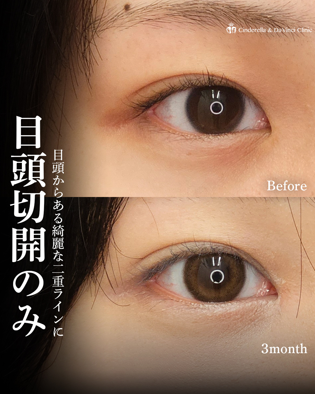 目頭切開で自然に目幅アップの画像