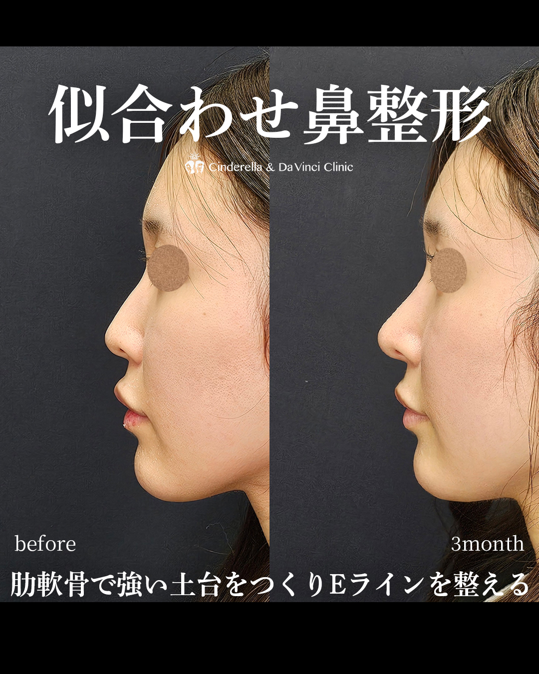 似合わせ鼻整形の画像
