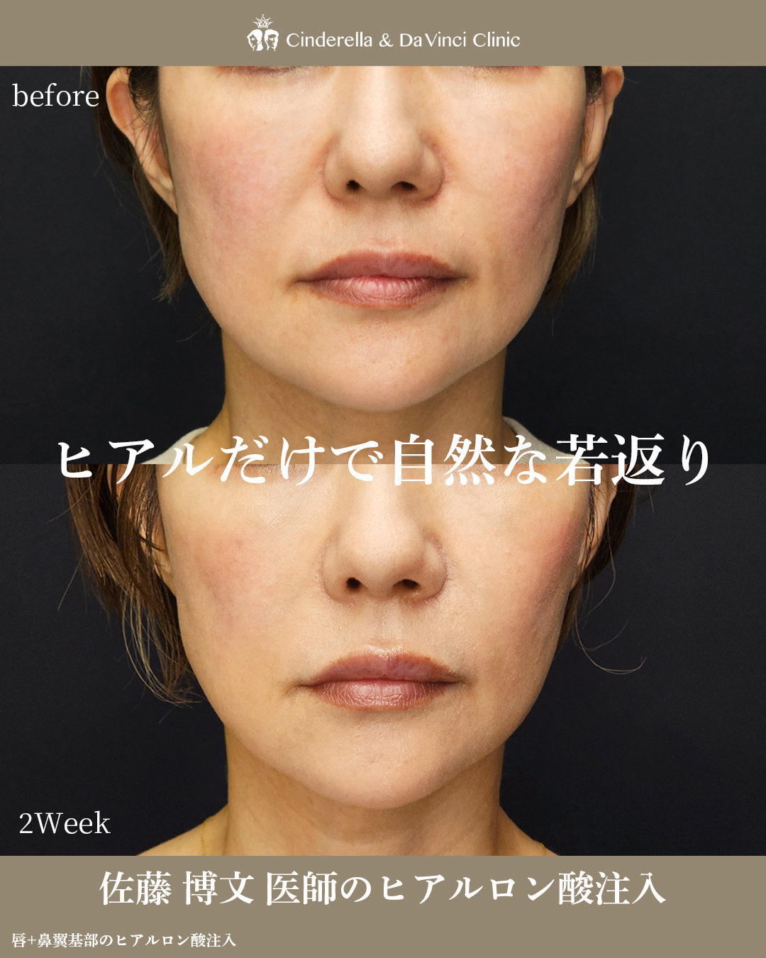 ヒアルだけで自然な若返りと垢抜けの画像