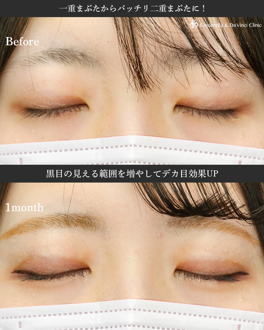 二重埋没で印象変化！可愛さUPの画像