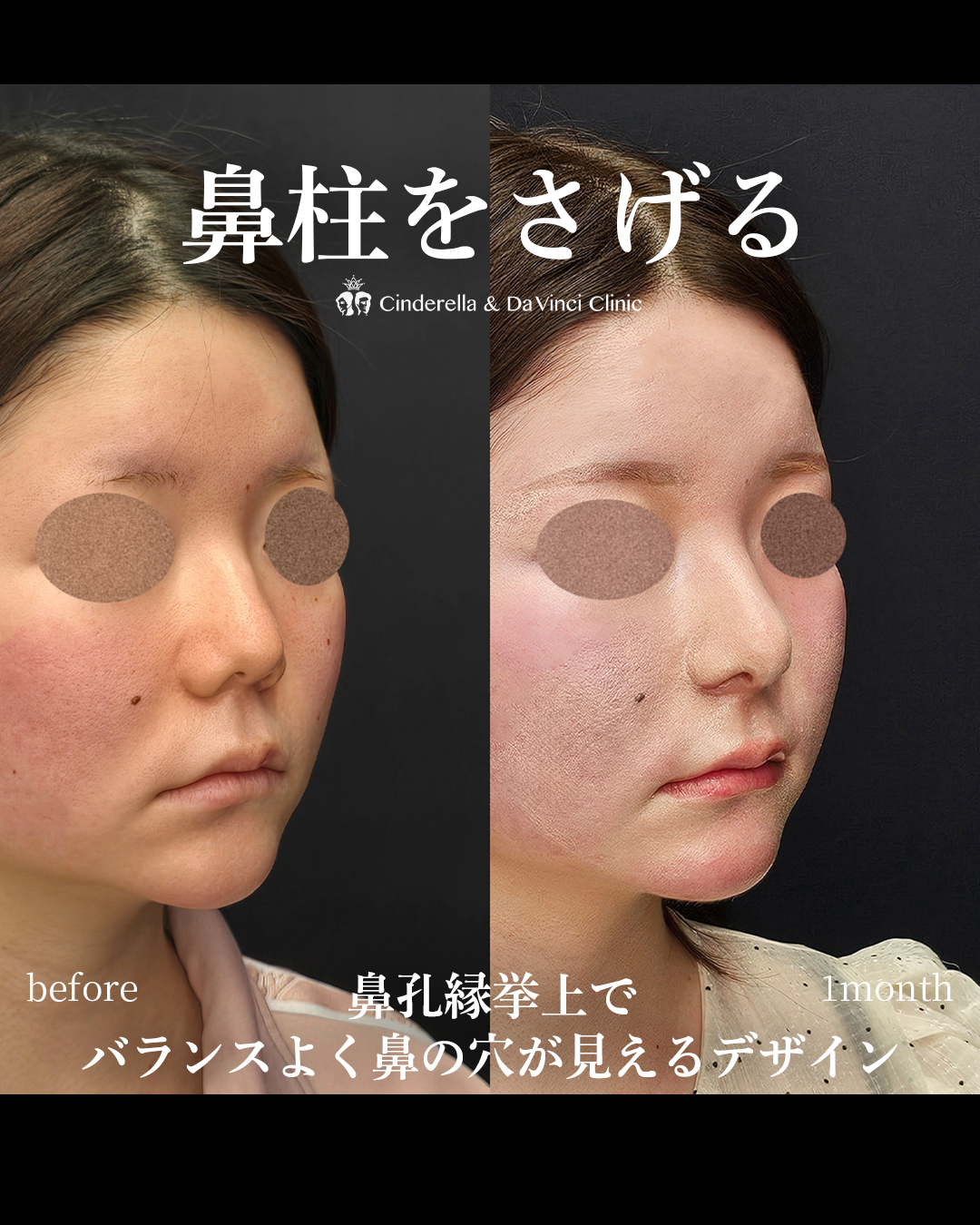 バランスよく自然な鼻の画像