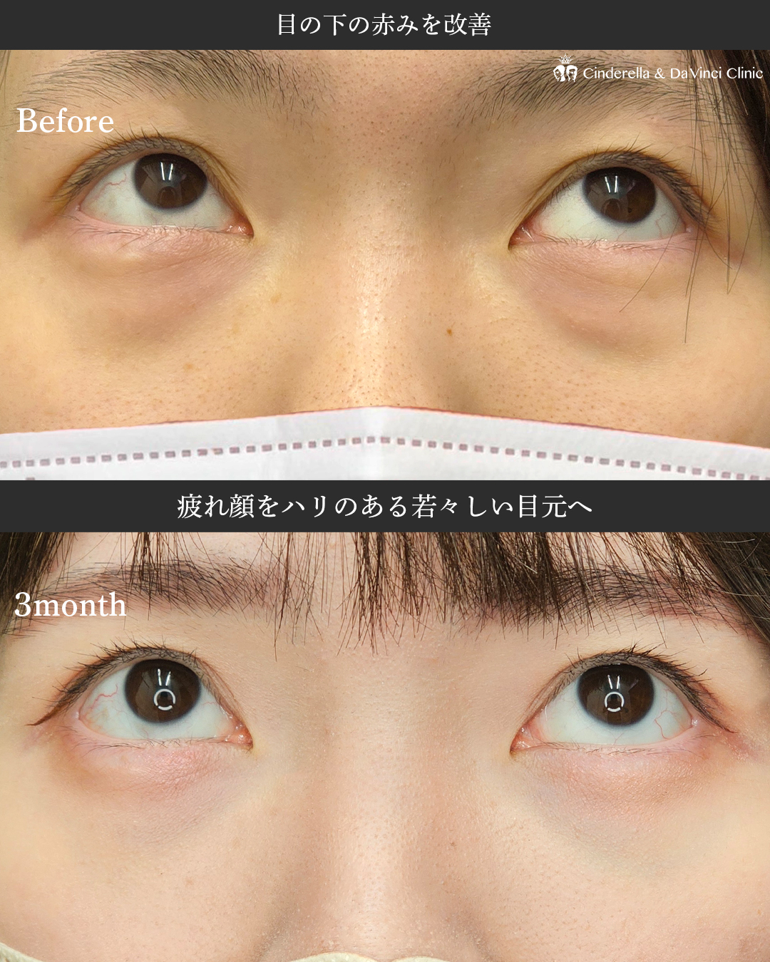 目の下のたるみを根本改善の画像