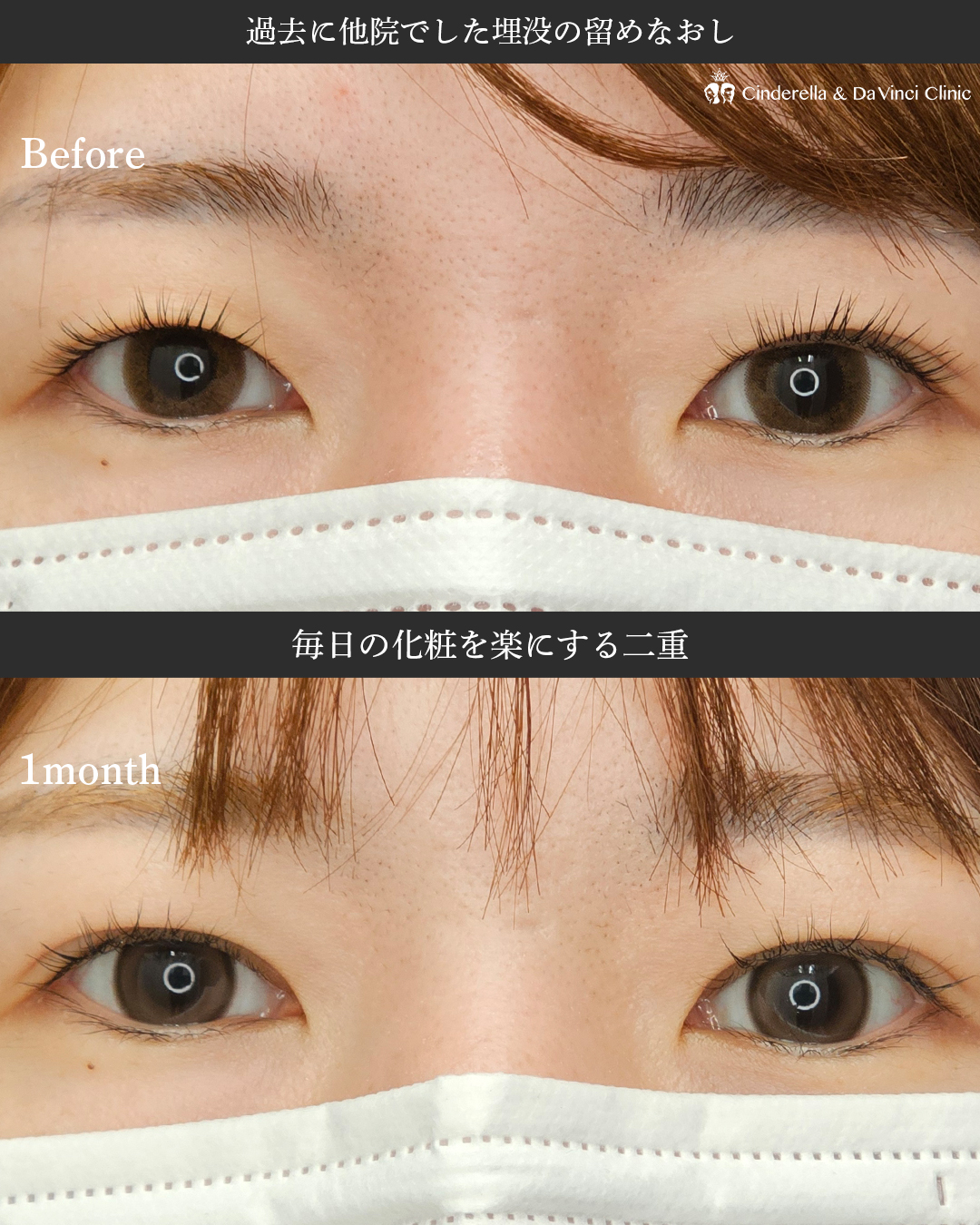 佐藤医師が作る自然な二重の画像