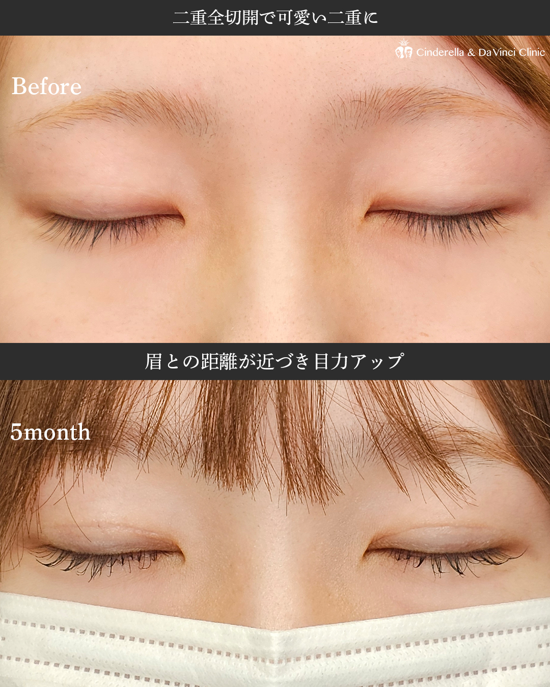 二重全切開法で可愛い二重にの画像