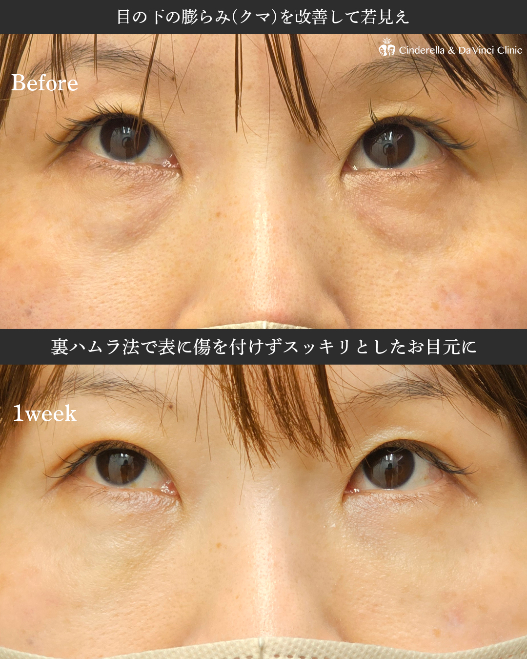 裏ハムラ法1週間で既にスッキリの画像