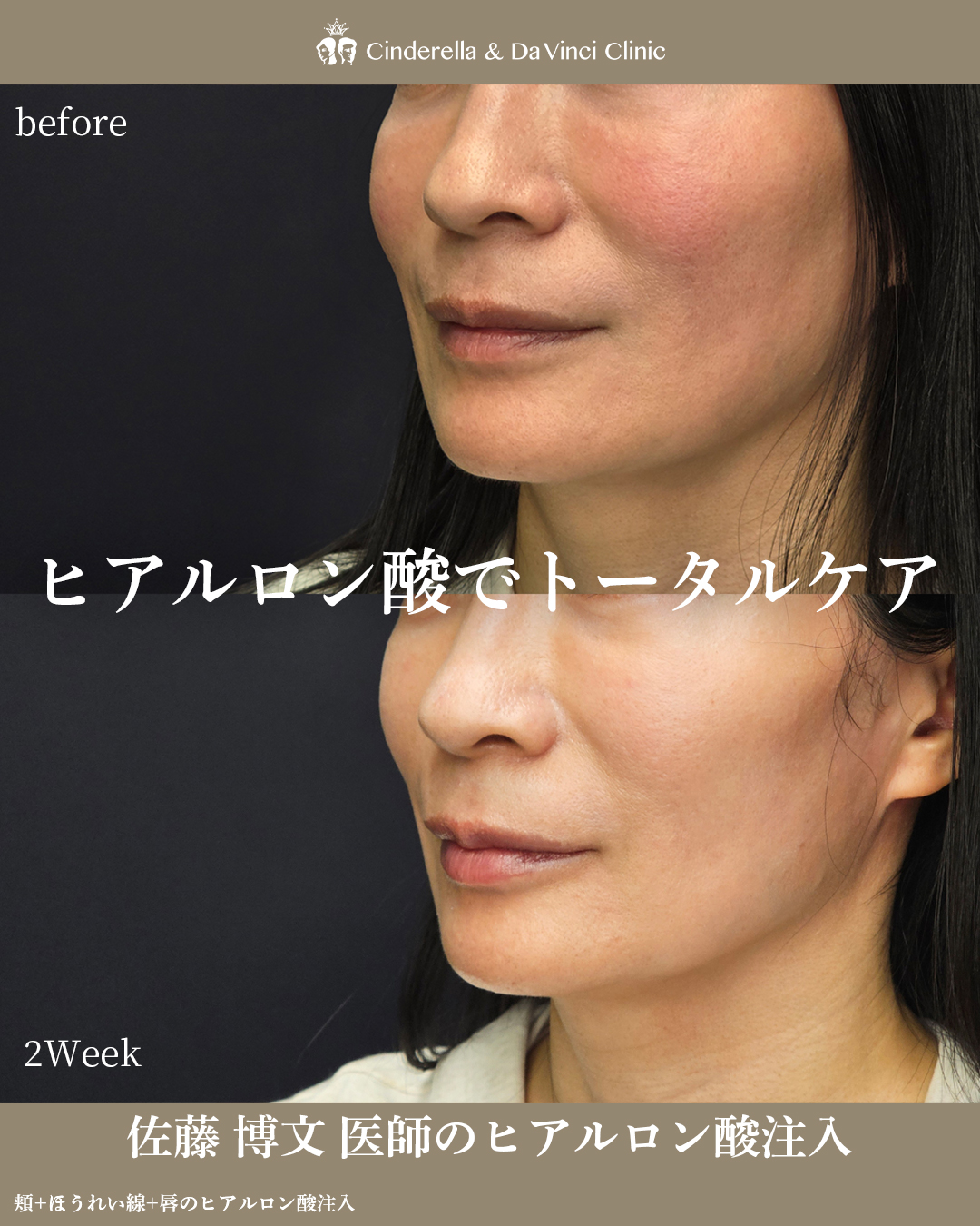 ヒアルロン酸でトータルケアの画像