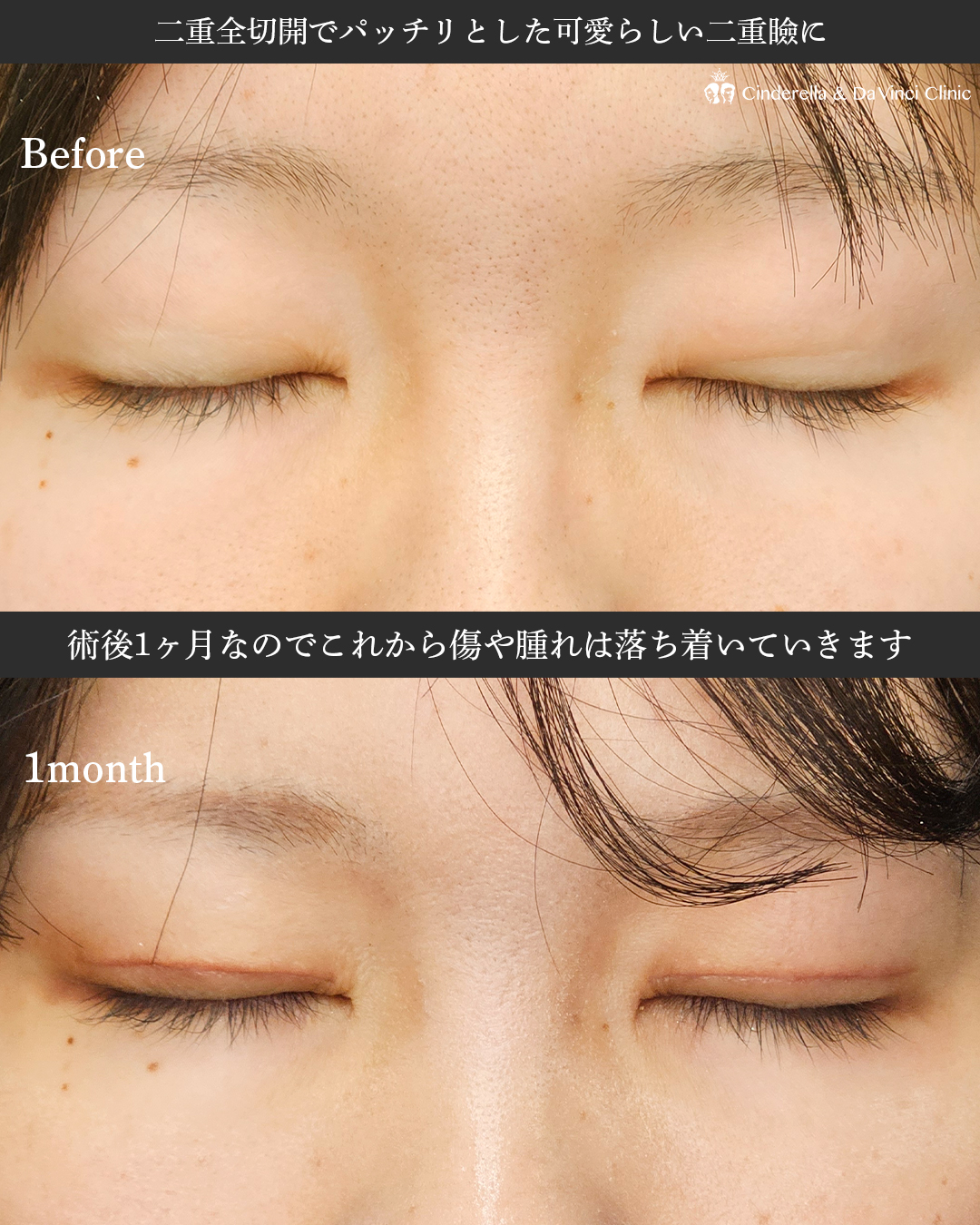 二重全切開で綺麗な二重にの画像