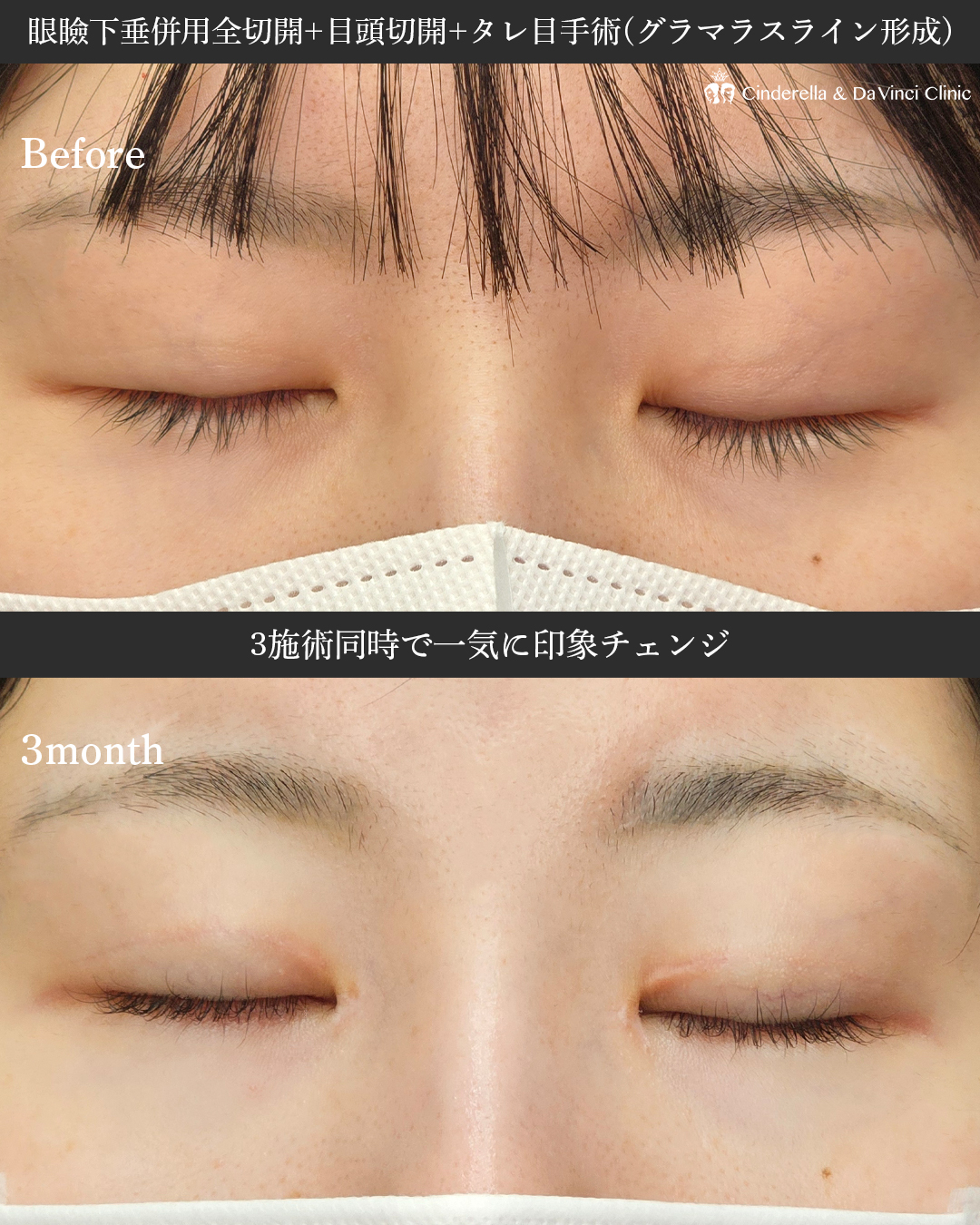 3術式で叶える理想の大きな目の画像