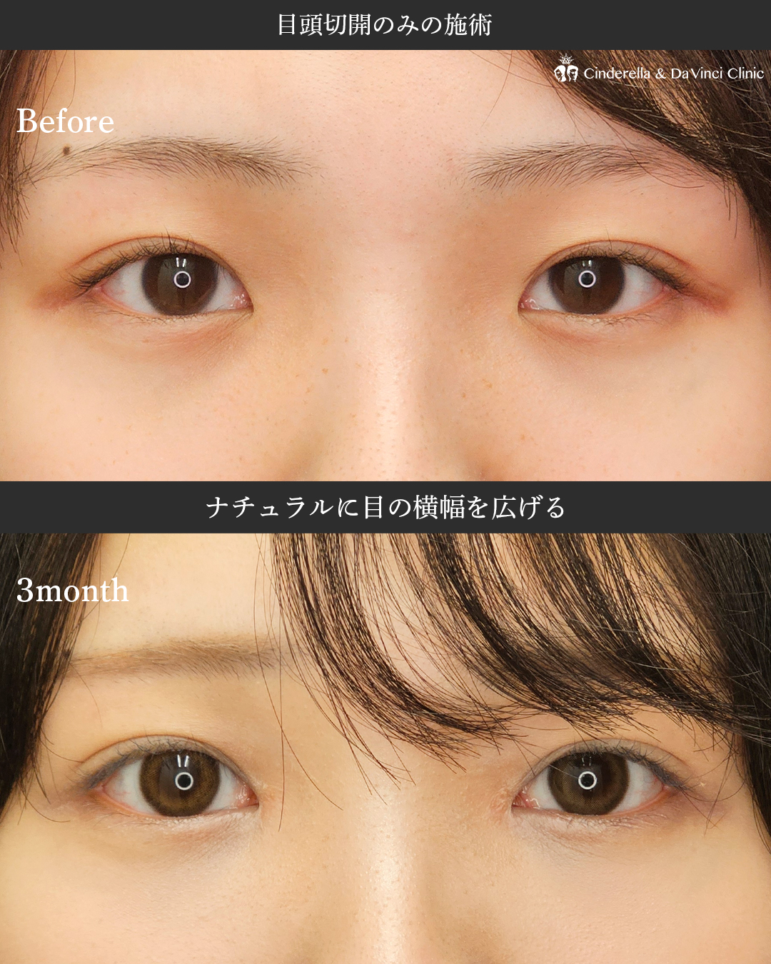 目頭切開で自然に目幅アップの画像
