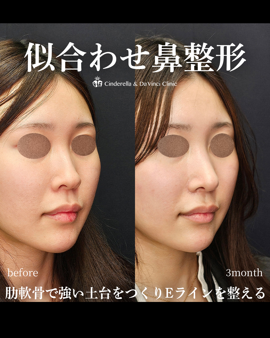 似合わせ鼻整形の画像